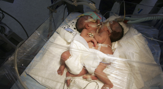 Сиамски близначки от Бутан бяха разделени с 6-часова хирургична операция